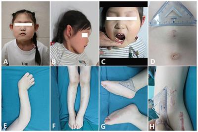 Diaphyseal and Metaphyseal Modeling Defects—Clinical Findings and Identification of WRAP53 Deficiency in Craniometadiaphyseal Dysplasia